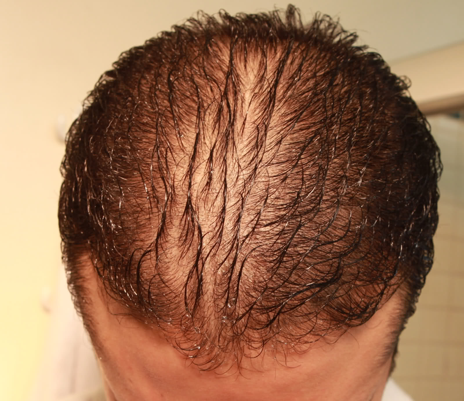 Thinning